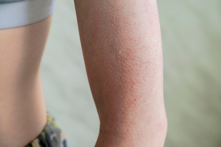 Follicular hyperkeratosis is located on the person's arm