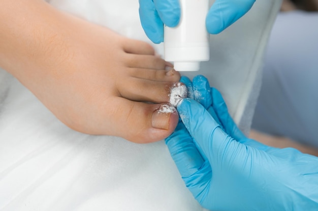 Photo following nail removal the podologist dusts an antiseptic powder onto the toe area