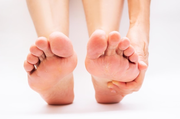 Foot pain from uncomfortable shoes female feet with flaky skin\
and corns a woman holds a sore foot