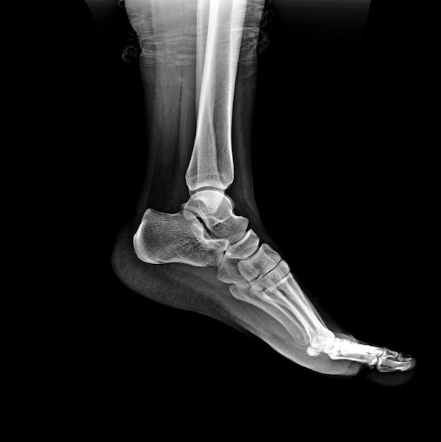 A foot with a broken toe and a bone on it