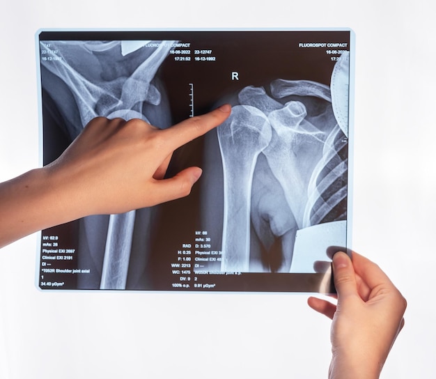 Forefinger pointing to trauma at arm Xray image Acromion acromial end fracture Doctor showing shoulder clavicle overuse injury Medical conditions identification and diagnosis