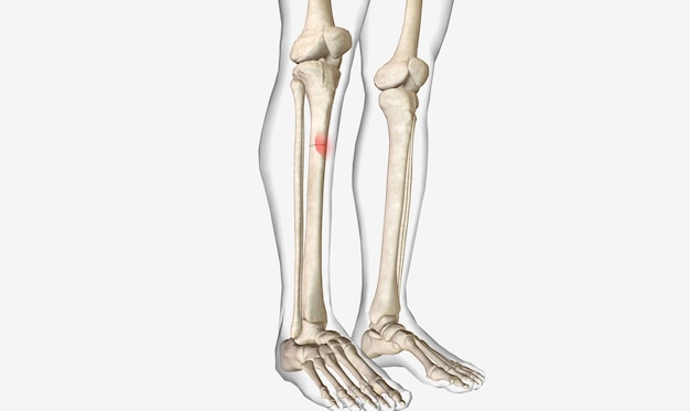 Photo a fracture is an acute injury that causes a partial or complete fracture of a bone