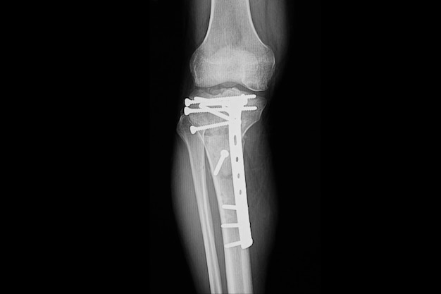 Fractured proximal tibia with plate and nails fixation