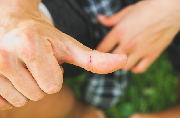 Fresh wound on man's finger. Accident with a cut on skin.