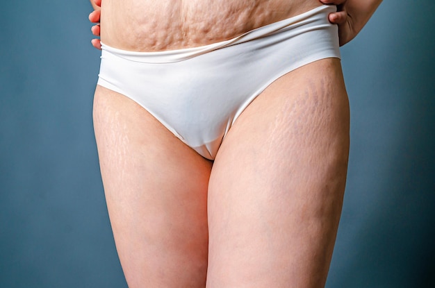 front view of skin of woman with stretch marks and flabby skin after childbirth naked belly and thighs of woman skin and body care