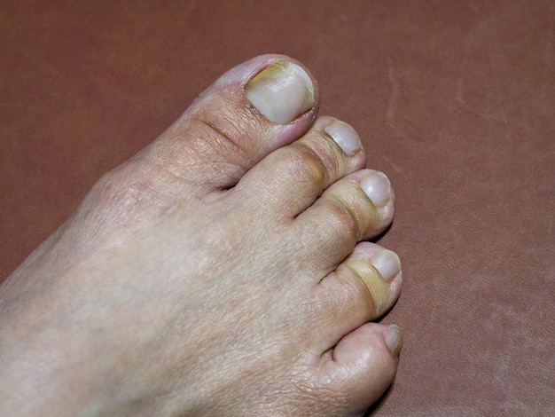fungal nail infection on a foot