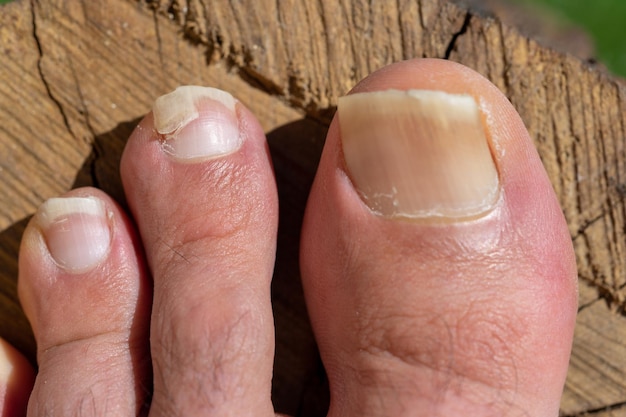 fungal toenail infection