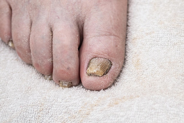 fungus infection on nails of mans footwhite backgroundindoors image