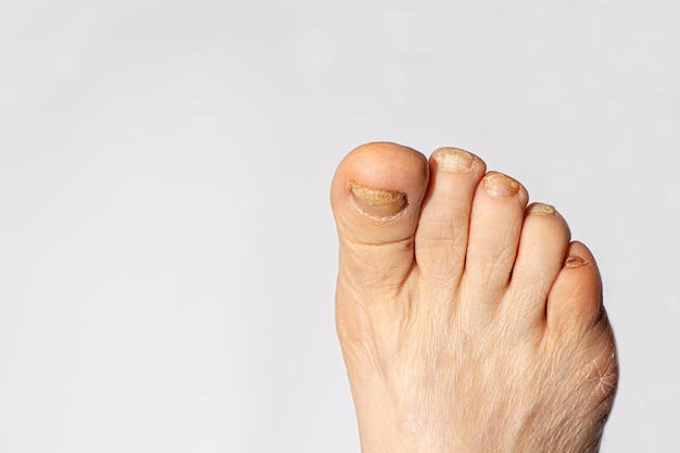 Fungus of nails on the big toe