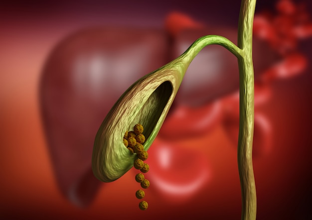 Gallbladder cutting showing gallstones obstructing bile duct on organic background. 3D rendering