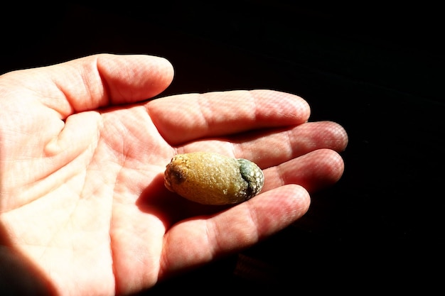 Photo gallstone disease cholelithiasis the formation of stones stones in the gallbladder bile ducts gallstones a large gallstone removed from a patient39s body 25 cm long