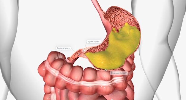 写真 胃出口閉塞とは、幽門または十二指腸に機械的閉塞がある状態です。