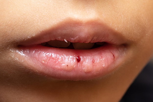 Gebarsten lippen van een kind met duidelijke tekenen van uitdroging