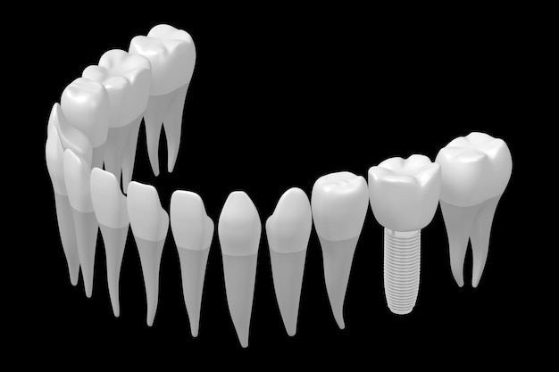 Foto gezondheid tanden en een implantaat geïsoleerd op witte achtergrond 3d illustratie