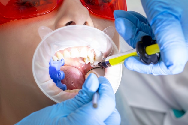 Девушка на осмотре у стоматолога. лечение кариозного зуба