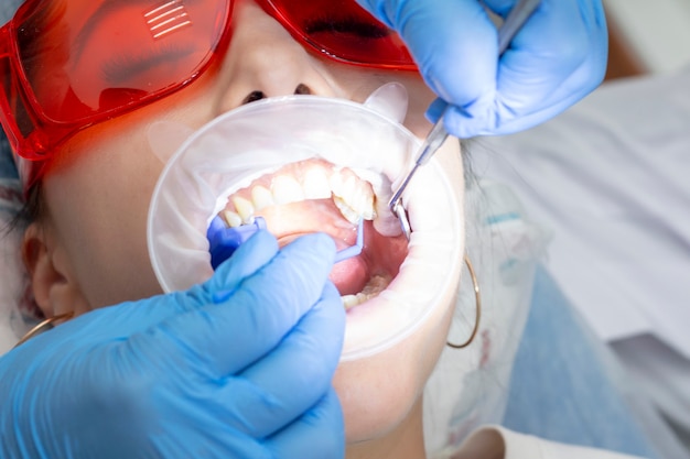 Girl patient at the reception at the dentist. treatment of carious tooth. the girl lies on the dental chair with his mouth open. A dentist and his assistant are treating a tooth