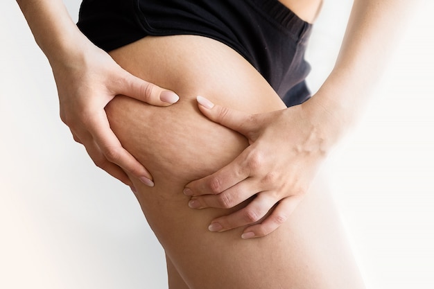 Girl shows holding and pushing the skin of the legs cellulite, orange peel. 