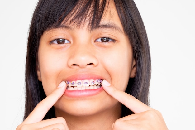 Ragazza con i denti di parentesi graffe che sorride e felice