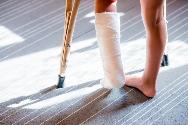 Girl with a broken leg, plaster bandage. foot splint for
treatment of injuries from broken bones. ankle sprain after jumping
on the trampoline