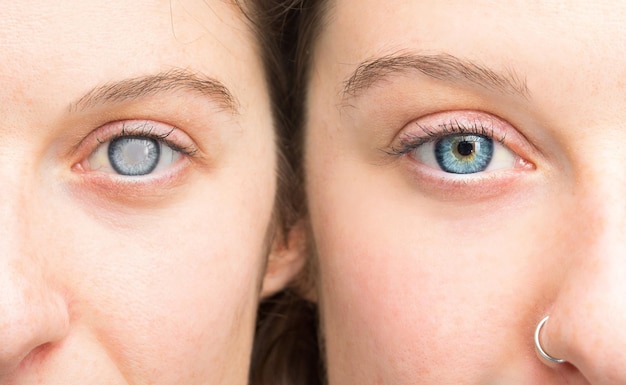 緑内障眼疾患の比較