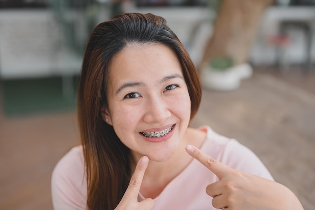 Glimlachende Aziatische vrouw die orthodontische pal draagt. Tandverzorging en gezonde tanden.