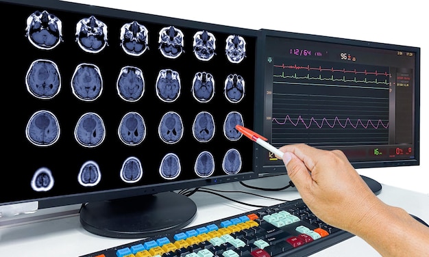 Photo glioblastoma brain metastasismri brain the doctor pointed out the location of the brain tumor on the computer screen