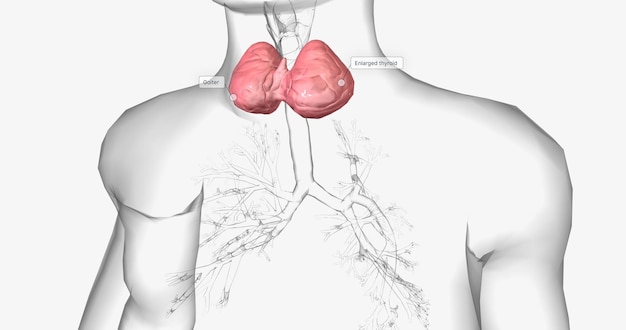 A goiter is a swollen rounded lump in the throat caused by the abnormal enlargement of the thyroid gland