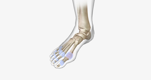 Photo gout is a common type of inflammatory arthritis a disease in which the immune system attacks bones and joints