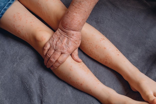 The grandmother's hands smear the little girl's feet with a special ointment for the treatment of irregularities