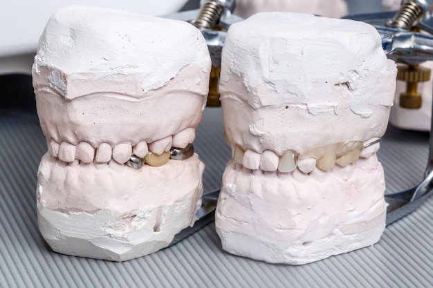 Foto stampo denti protesi dentali grigi, modello gengive umane in argilla