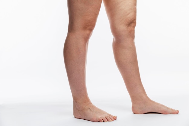 Groomed female legs with cellulite and varicose veins Disease and obesity White background