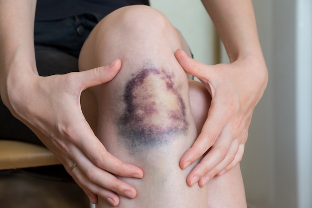 Foto grote blauwe plek schade op knie van jonge vrouw