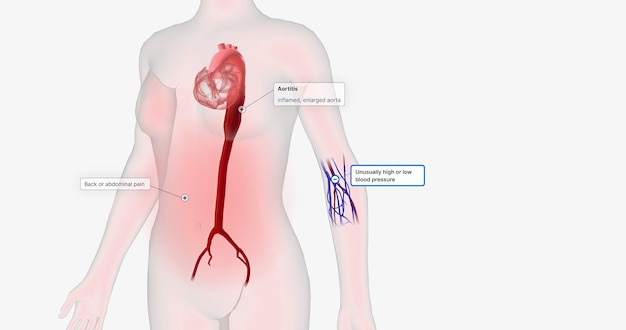 Grote hoeveelheden immuuncellen infiltreren de ontstoken aorta