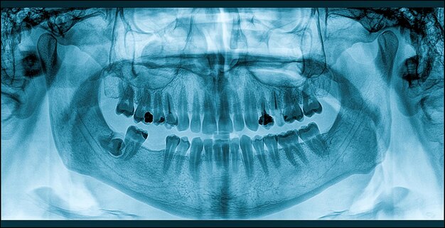 写真 成長する知恵の歯痛はx線で