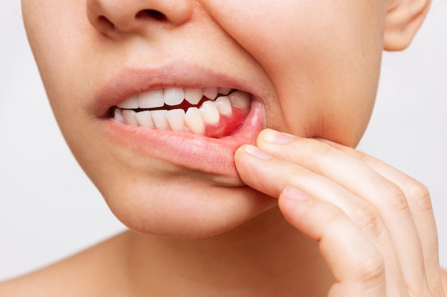 Gum inflammation Cropped shot of a young woman showing red bleeding gums