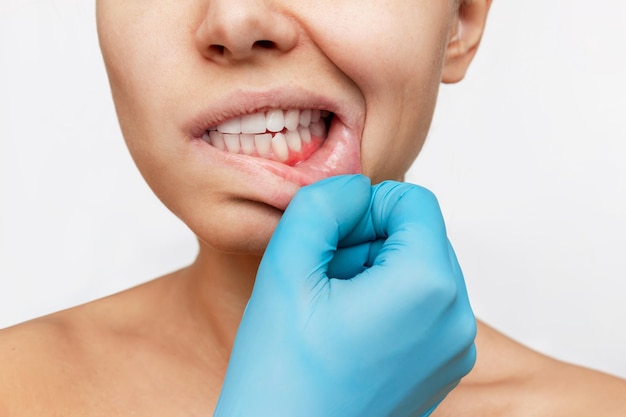 Gum inflammation. Young woman's face with doctor's hand in a blue glove on the jaw showing red gums