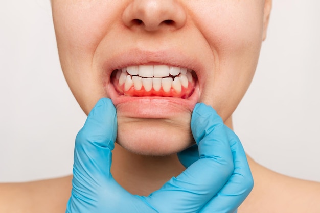 Gum inflammation A young womans face with doctors hand in a blue glove showing red bleeding gums