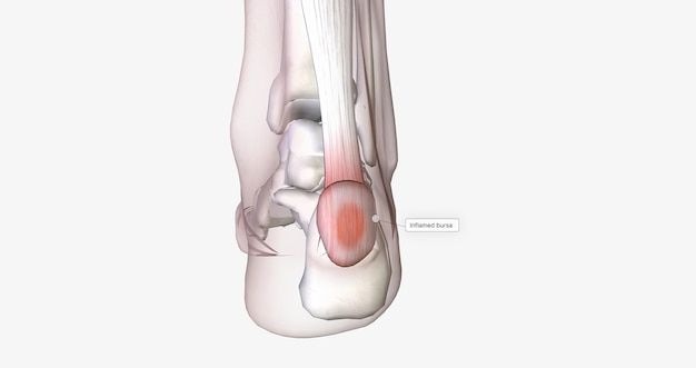 Haglunds deformity is bony enlargement at the back of the heel leading to painful bursitis