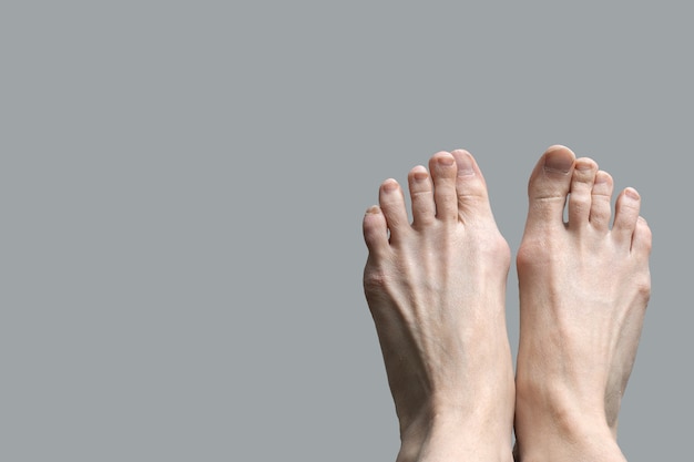 Hallux valgus, бурсит стопы на сером фоне. Деформация суставов стопы. Проблема здравоохранения и медицины с человеческим телом.