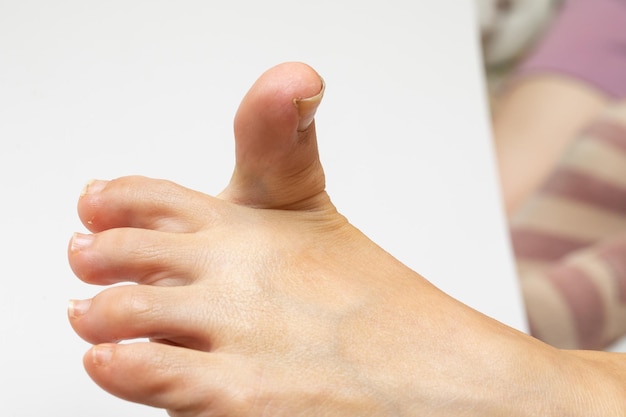 Hallux valgus risico concept vrouwelijke voet met grote teen naar boven gericht