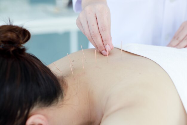 Photo hand of doctor performing acupuncture therapy . asian female undergoing acupuncture treatment with a line of fine needles inserted into the her body skin in clinic hospital