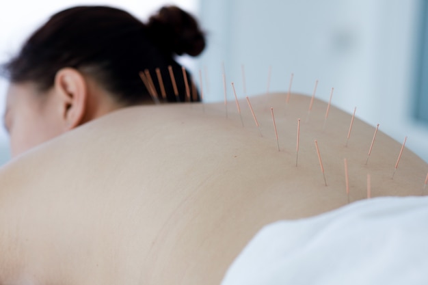 Hand of doctor performing acupuncture therapy . Asian female undergoing acupuncture treatment with a line of fine needles inserted into the her body skin in clinic hospital