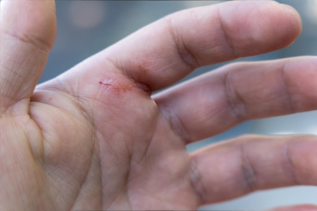 Hand fingers with accidental cut at home with space for text