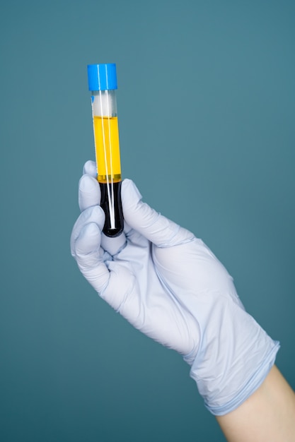 Hand girl doctor glove holds test tube with blood plasma