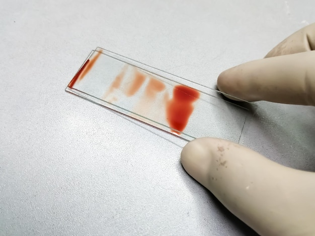 Hand of histologist prepare cytological slide from FNAC sample