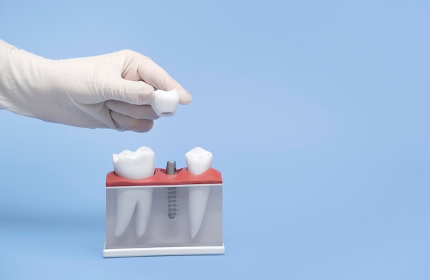 Hand holds a model of tooth implantation.