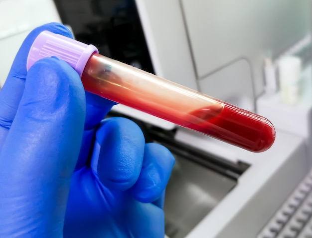Hand met bloedmonster in vacuümbuis voor hematologische analyse