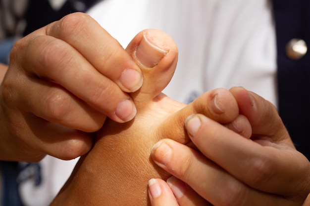 Hand opening the toes of one foot woman doing an inspection to\
check for athlete\'s foot