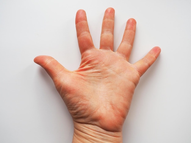 Hand palm on white background raised up hand palm to the viewer\
vote sign asking for help fortune telling on the lines in the palm\
of your hand palmistry dermatological problems dehydrated skin