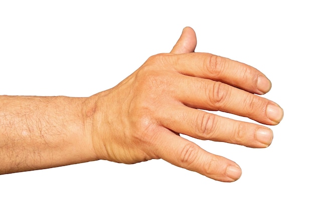 Hand unable to open fully due to deforming arthritis